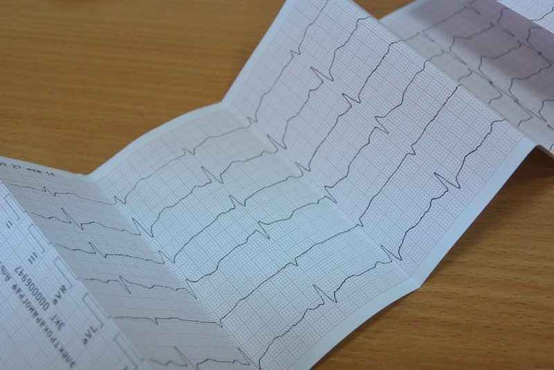 Электрокардиограмма вовремя выявила бессимптомный инфаркт Автор: Наталья Баграновская, ИА EAOmedia
